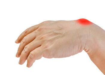 Bei einem Überbein handelt es sich um eine Zyste, die im Bereich einer Gelenkkapsel oder Sehnenscheide auftritt. (Bild: naiyanab/fotolia.com)