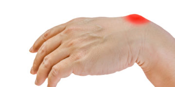 Bei einem Überbein handelt es sich um eine Zyste, die im Bereich einer Gelenkkapsel oder Sehnenscheide auftritt. (Bild: naiyanab/fotolia.com)