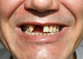 Angeschwollenes Zahnfleisch und Zahnausfall sind typische Symptome bei Skorbut. (Bild: irinaorel/fotolia.com)
