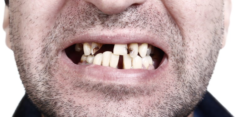Mit schlechte 30 zähne Zahnärzte bedanken