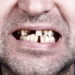 SInd die Zähne durch Karies und Parodontose ohnehin in einem schlechten Zustand, können diese auch bei normalen Belastungen abbrechen. (Bild: Igor Gromoff/fotolia.com)