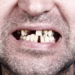 SInd die Zähne durch Karies und Parodontose ohnehin in einem schlechten Zustand, können diese auch bei normalen Belastungen abbrechen. (Bild: Igor Gromoff/fotolia.com)