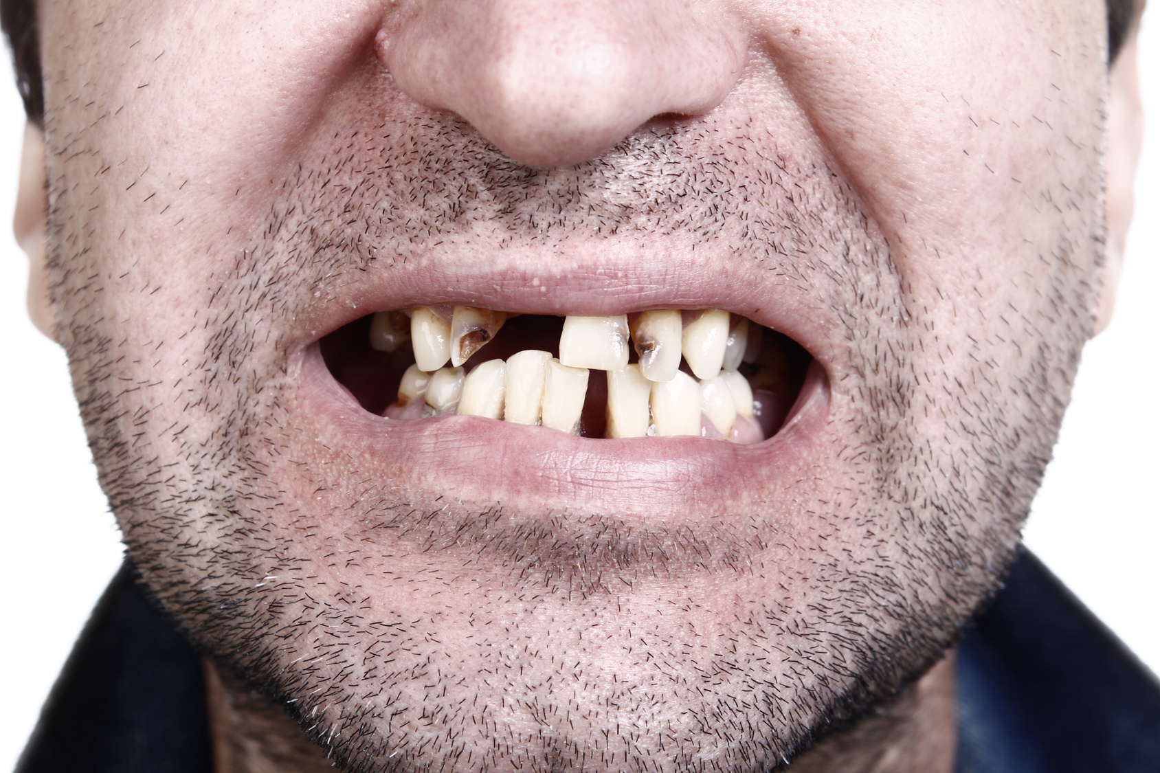 Wissenschaft: Aspirin kann den Zahnverfall umkehren und Zähne regenerieren.