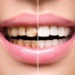 Braune Flecken auf den Zähnen können unterschiedliche Ursachen haben, nicht immer muss Karies der Auslöser sein. Oft lassen sich die Verfärbungen relativ leicht entfernen. (Bild: Subbotina Anna/fotolia.com)
