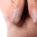 Schuppenflechte verursacht einen Hautausschlag, der oftmals an den Streckseiten der Arme auftritt, sich jedoch auch großflächig ausweiten kann. (Bild: Farina3000/fotolia.com)