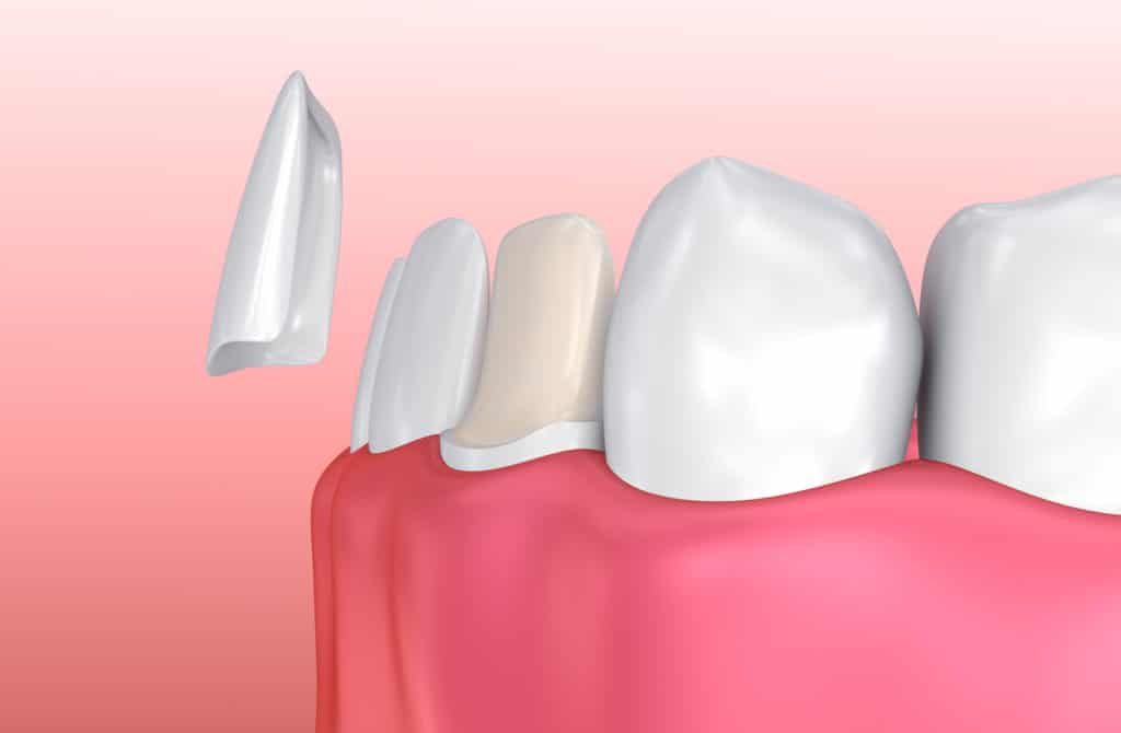 Abgebrochener Zahn Ursachen Und Therapie Naturheilkunde