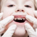 Ist Karies die Ursache der braunen Flecken auf den Zähnen, sollte dringend ein Zahnarzt aufgesucht werden, um weiterreichende Gesundheitsrisiken zu vermeiden. (Bild: ia_64/fotolia.com)