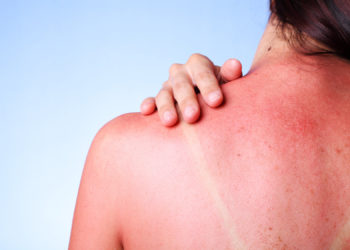 Frau mit Sonnenbrand auf dem Rücken