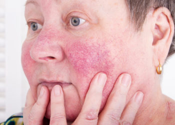 Anhaltende Gesichtsrötungen und Hautbrennen können ein Hinweis auf Rosacea sein. (Bild: Milan Lipowski/fotolia.com)