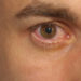 Herpes am Auge kann sich unter anderem durch Rötungen, Juckreiz oder ein Fremdkörpergefühl äußern. (Bild: andreaskoch02/fotolia.com)