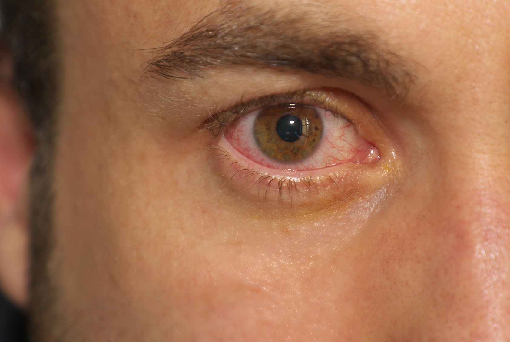 Am auge herpes arbeiten mit Wann wird