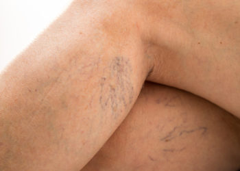 Besenreiser entstehen, wenn das Blut nicht mehr zum Herzen zurück fließt, sondern sich stattdessen in den Venen sammelt. (Bild: doroguzenda/fotolia,com)