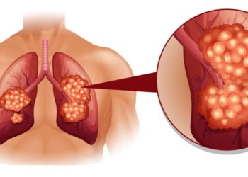 Schmerzhafter Husten kann auch im Zusammenhang mit Lungenkrebs auftreten, allerdings zeigt sich dieser meist erst im späteren Stadium der Erkrankung. (Bild: blueringmedia/fotolia.com)
