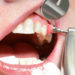 Bei einer professionellen Zahnreinigung werden die Beläge von den Zähnen beseitigt, was auch einem Zahnfleischrückgang und somit den offenen Zahnhälsen entgegenwirkt. (Bild: K.-U. Häßler/fotolia.com)