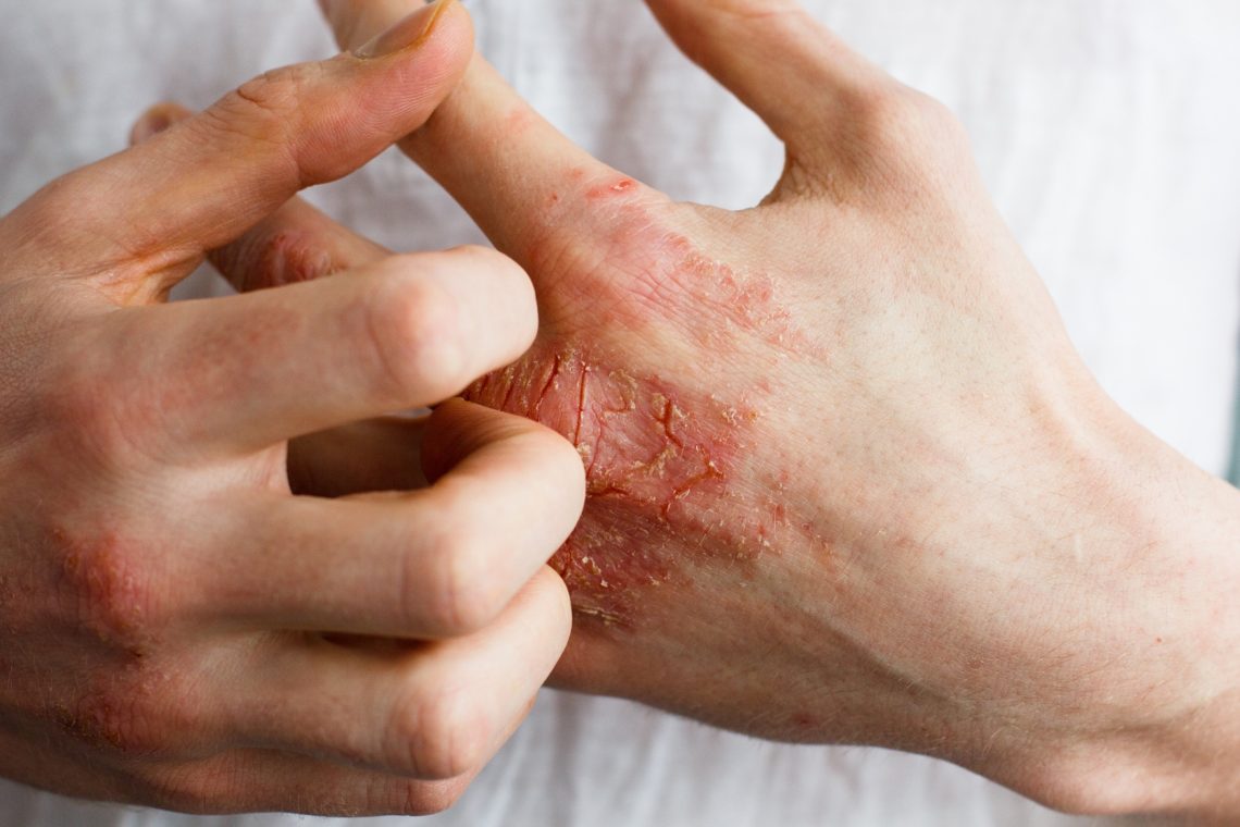 Schuppige Haut – Ursachen und Behandlung – Heilpraxis