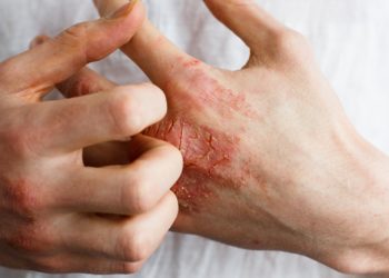 Gründe für rote Flecken auf der Haut können zum Beispiel eine Allergie oder ein Ekzem sein. (Bild: Ольга Тернавская/fotolia.com)