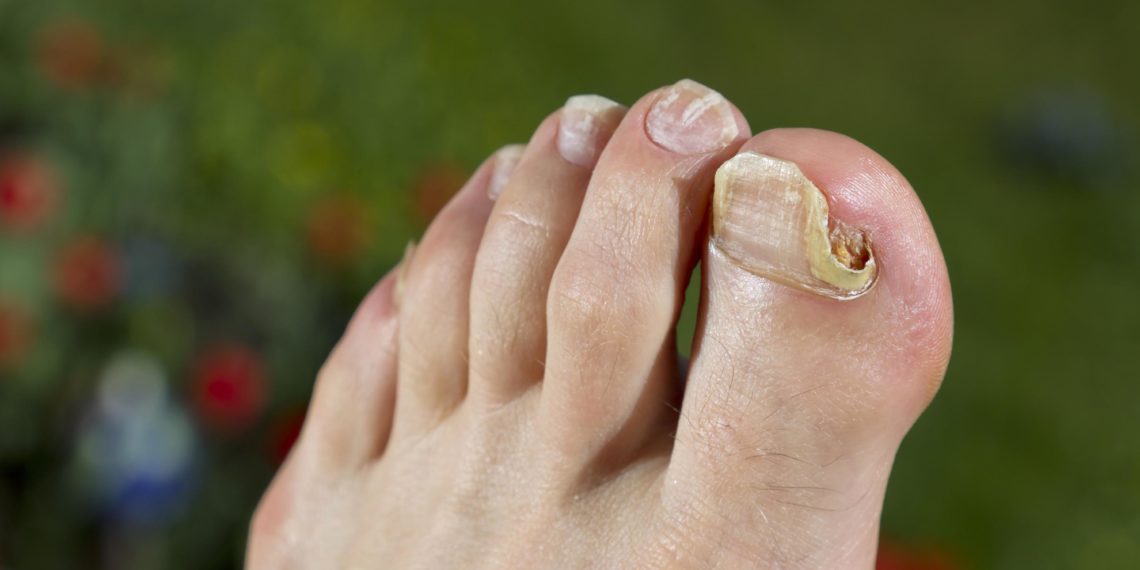 Nagelpilz Ursachen, Symptome, Hausmittel und Therapie Heilpraxis