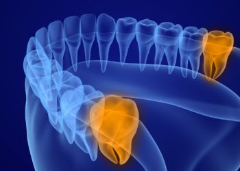 Die Weisheitszähne befinden sich ganz hinten im Mund, am Ende der Zahnreihe. Sie gelten als Relikt aus früheren Zeiten , als der Mensch noch ein größeres Gebiss hatte. (Bild: Alexandr Mitiuc/fotolia.com)