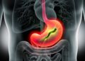 Die Typ-B-Gastritis ist die häufigste Form der chronischen Magenschleimhautentzündung. Sie wird meist durch das Bakterium Helicobacter pylori ausgelöst. (Bild: psdesign1/fotolia.com)