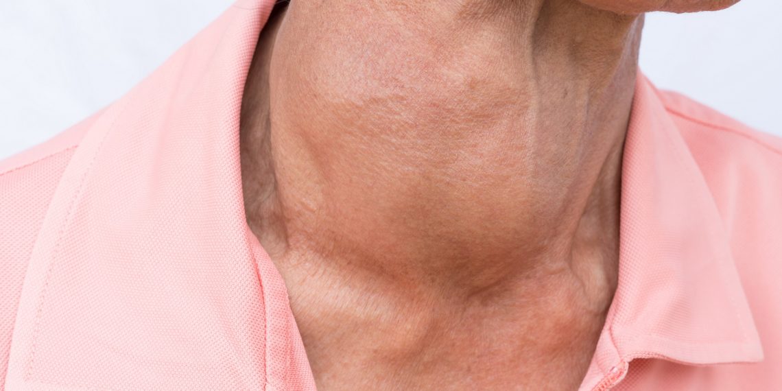 Geschwollene Schilddrüse – Kropf: Ursachen, Symptome und Behandlung ...
