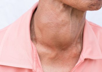 Eine Schilddrüsenschwellung  mit Grad III ist sehr stark ausgeprägt und deutlich erkennbar. (Bild: chatuphot/fotolia.com)