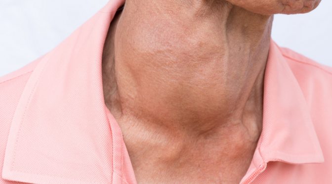 Geschwollene Schilddrüse Kropf Ursachen, Symptome und Behandlung