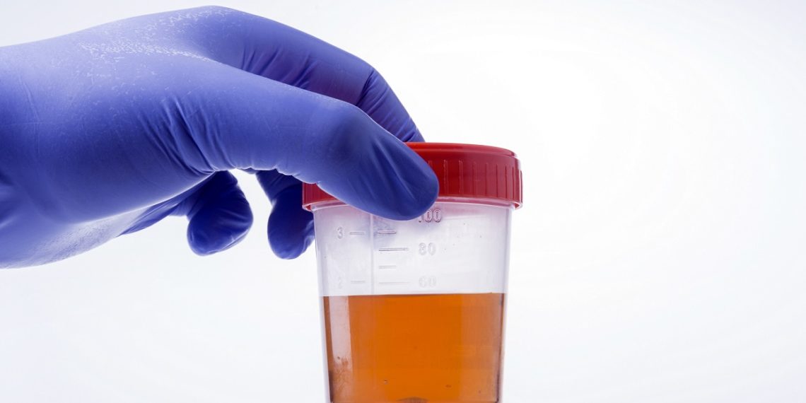 Experte Alarmzeichen Blut im Urin was hat das zu bedeuten? Heilpraxis