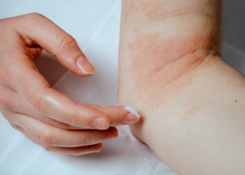 Neurodermitis betrifft nicht nur Kinder. (Bild: Milton Oswald/fotolia.com)