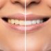 Der Zahnarzt hellt verfärbte Zähne mit hoch konzentriertem Bleichmittel auf. (Bild: blackday/fotolia.com)