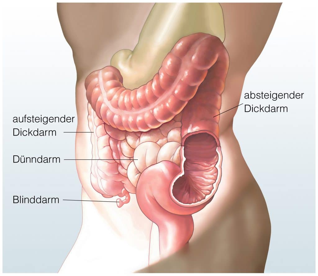 Was ist eine Darmkolik? 