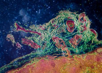 Eine Lymphgefäßsentzündung kann sich auf die Lymphknoten ausweiten, wenn die Bakterien ins dortige Lymphgewebe gelangen (Bild: defun/fotolia.com)