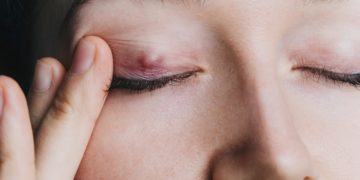 Ein Hagelkorn verusacht in den meisten Fällen kaum Beschwerden und heilt in der Regel nach einiger Zeit wieder ab. Allerdings können ausgeprägtere Formen durchaus zu Komplikationen führen. (Bild: wifesun/fotolia.com)