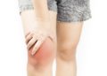Eine Schleimbeutelentzündung am Knie kann eine starke, schmerzhafte Schwellung verursachen. (Bild: TANABOON/fotolia.com)