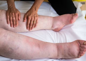 Füße einer Person, die von einem Lymphödem betroffen ist.
