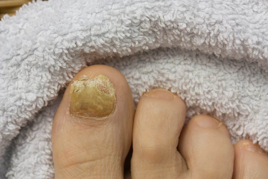 Fungal infections (mycoses) - symptoms, causes and treatment - All My