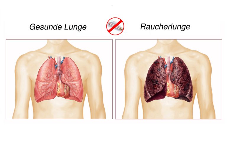 Lunge Nach 20 Jahren Rauchen