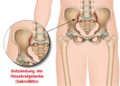Schaubild Sakroiliitis