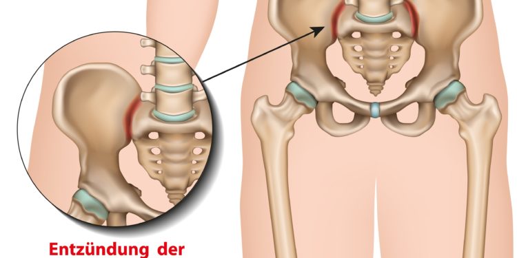 Schaubild Sakroiliitis