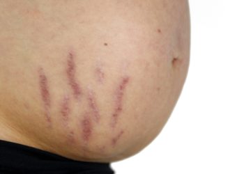 Schwangerschaftsstreifen sind feine Risse im Unterhautgewebe, die rötlich-blau durchscheinen. (Bild: juefraphoto/fotolia.com)