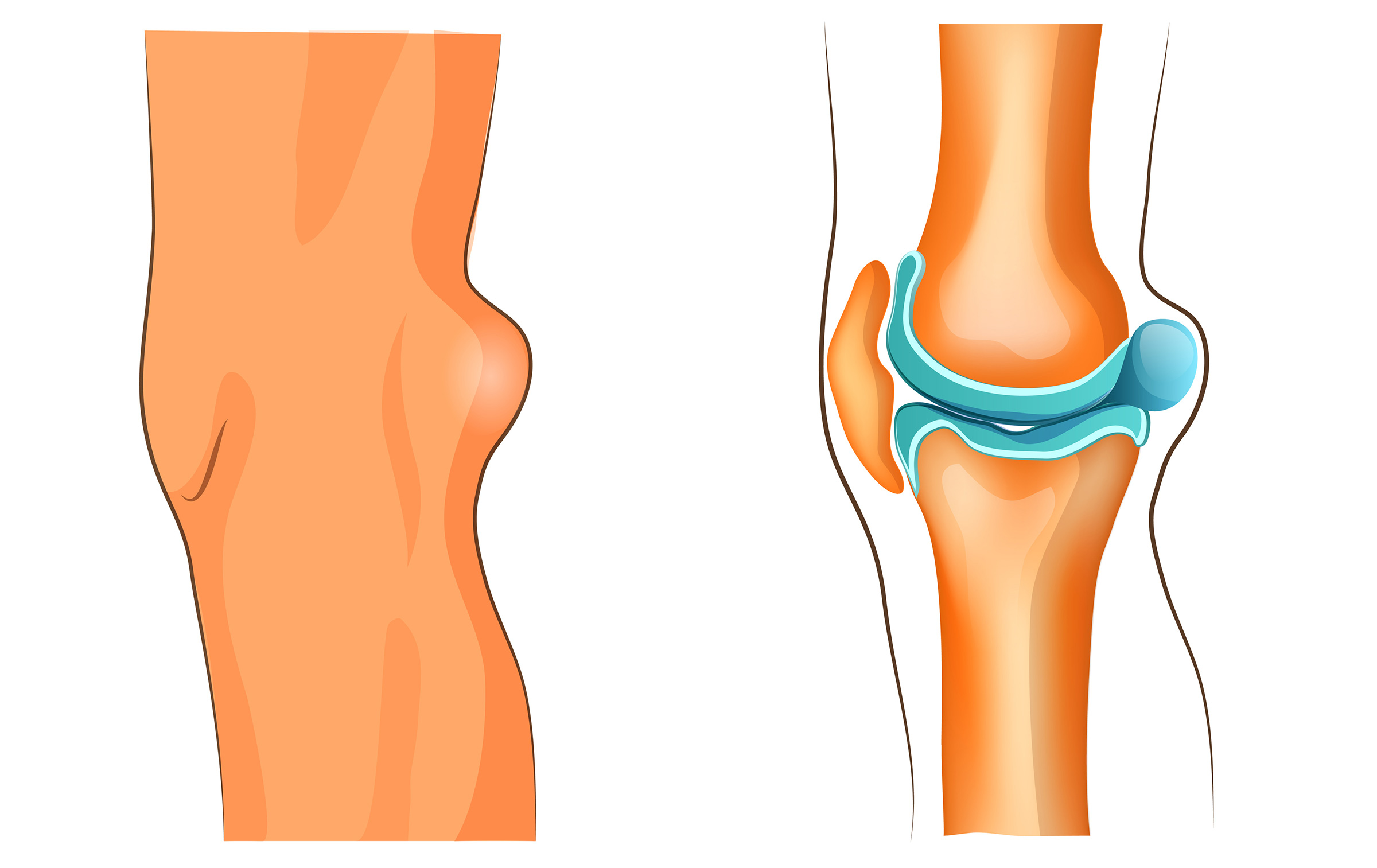 Подколенная киста коленного сустава