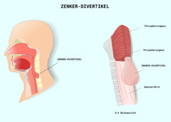 Das Zenker-Divertikel ist die häufigste Divertikelerkrankung in der Speiseröhre (BILD: fotolia/ellepigrafica)