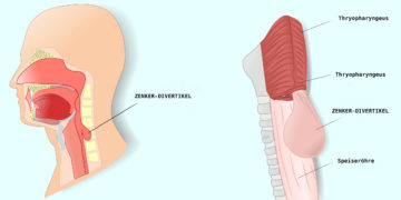Das Zenker-Divertikel ist die häufigste Divertikelerkrankung in der Speiseröhre (BILD: fotolia/ellepigrafica)