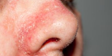 Eine rote Nase kann unterschiedlichste Ursachen haben, wobei dauerhafte Rötungen oftmals in Zusammenhang mit Hauterkrankungen stehen. (Bild: Nancy/fotolia.com)