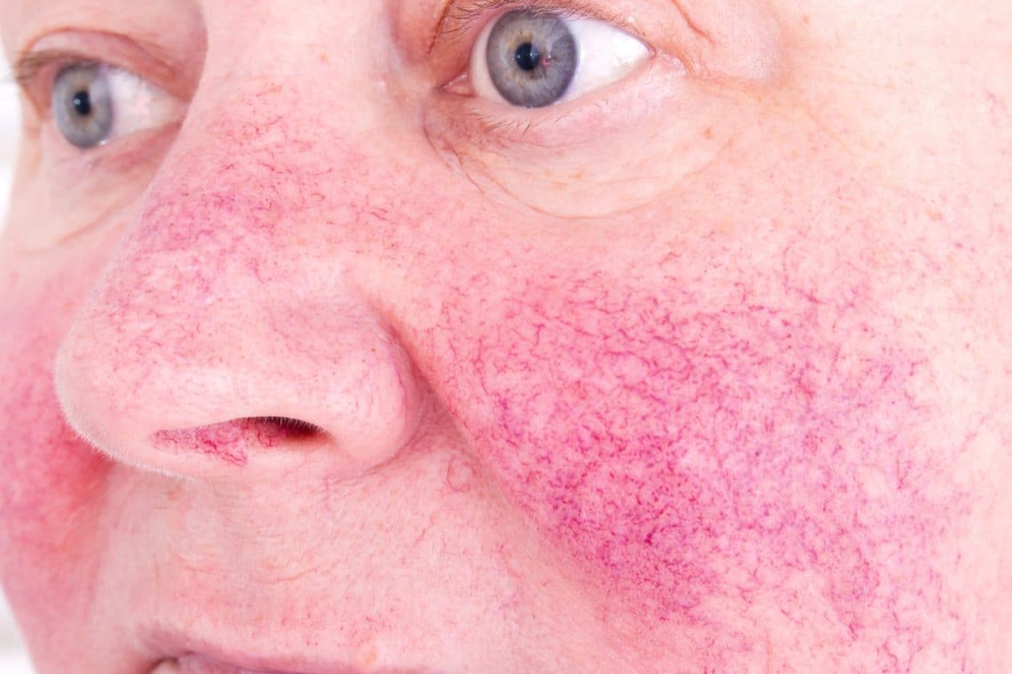 Rote Nase Ursachen und Behandlung Heilpraxis