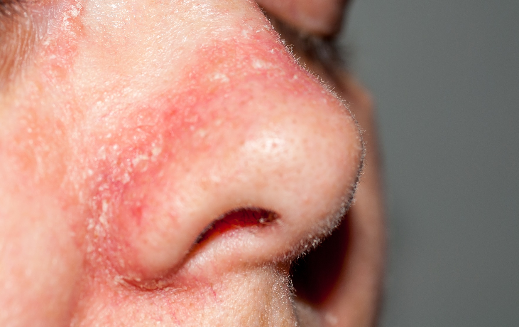 Rote Nase - Ursachen und Behandlung - Heilpraxis