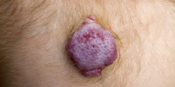 Bei Neugeborenen bilden sich Blutschwämme ((Hämangiome) in den ersten Lebensjahren von alleine zurück (Bild: Franziska Krause/fotolia.com)