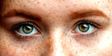 Sommersprossen gehören zu den medizinisch unproblematischen Gesichtsflecken, können aber psychologisch einen  Leidensdruck verursachen. (Bild: alfa27/Fotolia.com)