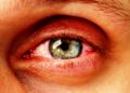 Ein Entzündung im Auge kann zu einem Augeninfarkt führen, gleichzeitig aber auch das Symptom eines solchen sein. (Bild:  Sergey/fotolia.com)