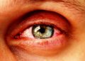 Ein Entzündung im Auge kann zu einem Augeninfarkt führen, gleichzeitig aber auch das Symptom eines solchen sein. (Bild: Sergey/fotolia.com)