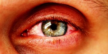 Ein Entzündung im Auge kann zu einem Augeninfarkt führen, gleichzeitig aber auch das Symptom eines solchen sein. (Bild:  Sergey/fotolia.com)